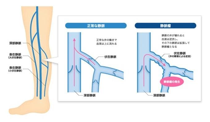 正常な静脈と静脈瘤で血液が逆流する様子を比較した図